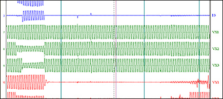 PulseClosing Technology Saves Transformers from the Stress of Damaging Fault Current, overhead automation, automation system, fault interrupter, protecting equipment, distribution fault protection equipment, power module, visible air gap